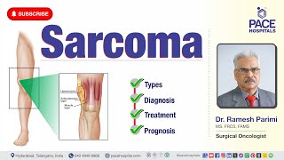 Sarcoma Cancer  Types Diagnosis Treatment amp Prognosis  sarcomatreatment [upl. by Corilla620]