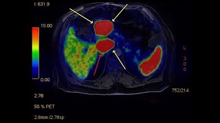 Signs you may have a pancreatic neuroendocrine tumor  Mayo Clinic [upl. by Thaine]