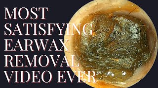 Most SATISFYING Earwax Removal Video EVER [upl. by Bilski886]