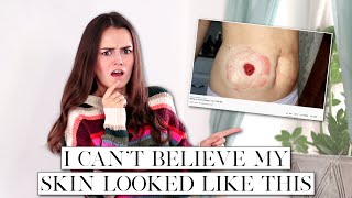 How I Healed the Skin Around My Stoma  Lets Talk IBD [upl. by Erie]