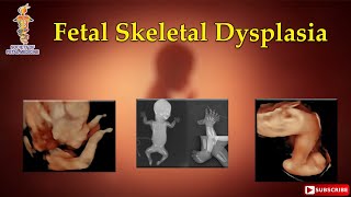 Fetal Skeletal Dysplasia [upl. by Lakim]