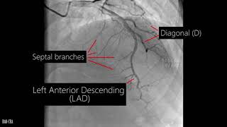 Anatomy of the left anterior descending artery [upl. by Casta351]