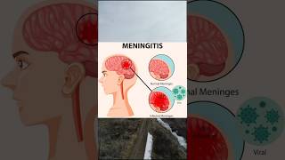 Meningitismedicine healthtips mbbs physiologyhealth healthcaresymptoms treatmentmeningitis [upl. by Stanislaw]