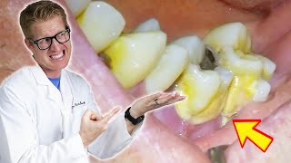 Patients Tooth FALLS OUT During Deep Cleaning TONS OF PLAQUE TARTAR amp GROSS Bacteria Removed [upl. by Atihcnoc]