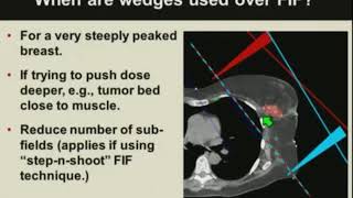 Basics of Breast Cancer Radiotherapy Treatment Planning [upl. by Chick]