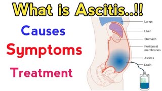 causes of ascites fluid in abdomen  treatment of ascites due to liver cirrhosis  ascites fluid [upl. by Carma]