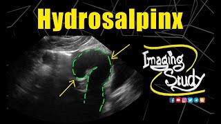 Hydrosalpinx  Ultrasound  Case 202 [upl. by Henig]