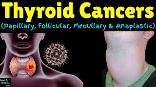 Thyroid Cancers Papillary Follicular Medullary amp Anaplastic  Classification of Thyroid Neoplasm [upl. by Hctim]