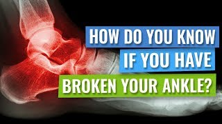 How Do you Know Whether you Have Broken your Ankle [upl. by Ecnerolf]