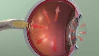 Animation Glaucoma [upl. by Phelan]