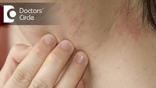 How to identify scabies rash amp its management  Dr Sudheendra Udbalker [upl. by Adhern]