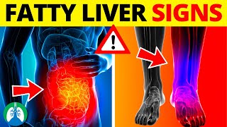 ⚡ Top 10 Signs and Symptoms of Fatty Liver You MUST AVOID [upl. by Narod]