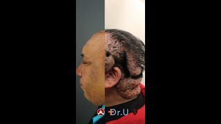 Acne Keloidalis Nuchae AKN Transformation by Dr U [upl. by Congdon183]