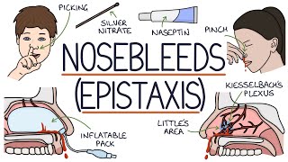 Understanding Nosebleeds Epistaxis [upl. by Steiner]