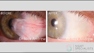 Pterygium surgery explained [upl. by Sotsirhc765]