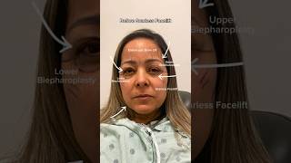 Scarless Facelift Upper Eyelid Surgery amp Lower Eyelid Surgery scarlessfacelift [upl. by Welcher]