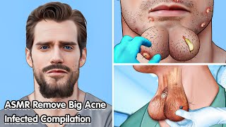 ASMR Remove Big acne Dogtick Infected Compilation  Deep Cleaning Animation [upl. by Kahn973]