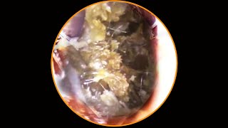 Satisfying Ear Wax Removal With Dr Zhao Video 61 [upl. by Meerek]