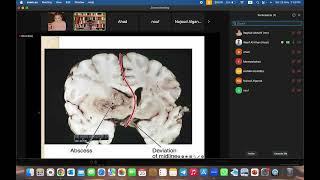 Pathology CNS tutorial with Dr Wasif part 2 [upl. by Teferi242]