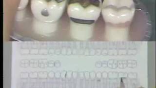 Dental Charting Procedures [upl. by Villada]