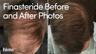 Finasteride Results Finasteride Before and After Photos [upl. by Ilene]