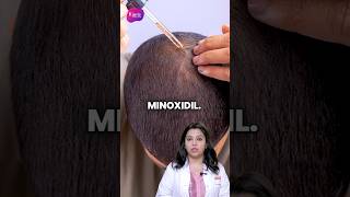 How to Apply Minoxidil  How to use Minoxidil for Hair  Minoxidil For Hair Growth  Kiara Clinic [upl. by Edmea730]