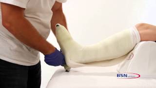 Application technique of Cutimed Total Contact Cast [upl. by Anisamot]