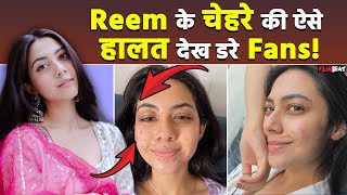 Reem Shaikh के चेहरे की इतनी बुरी हुई हालत चोटों के निशान देख फैंस घबरा गए  FilmiBeat [upl. by Eek158]