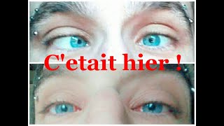 Lendemain doperation du strabismeTOUT VA BIEN strabismus operation [upl. by Merrel]