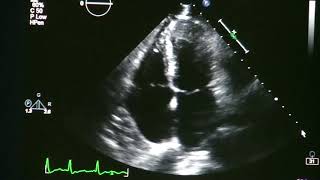 Atrial Fibrillation On Echocardiogram [upl. by Aicenaj910]