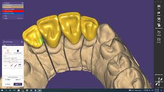 Exocad How to design cutback Crown [upl. by Aciretehs]