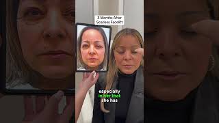 Scarless Facelift amp Browlift faceliftnyc bestfacelift faceliftbeforeandafter facelifts browlift [upl. by Meldon375]