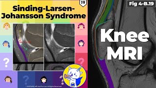 Fig 4B19 SindingLarsenJohansson Syndrome [upl. by Ynohtnaleahcim]