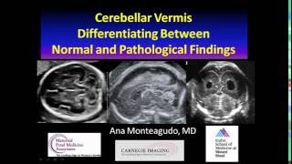 AIUM Webinar Cerebellar Vermis [upl. by Asare]