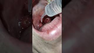 Tonsil Stone Removal using Water Irrigation to Reduce Irritation [upl. by Elgar]