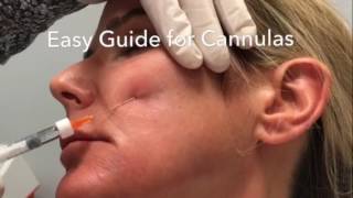 Easy Guide System for Blunt Cannulas  Dermal Fillers  Steven F Weiner MD [upl. by Ojadnama]