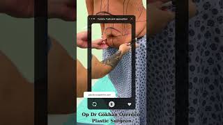 Tummy Tuck and Liposuction Antalya Turkey Op Dr Gokhan Ozerdem Plastic Surgery [upl. by Aun995]