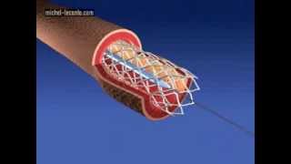 coronary artery stenting [upl. by Ellard]