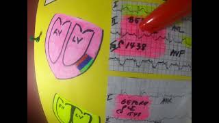 ENG1A LATE ANTERIOR STEMI ECG BEFORE AND AFTER PCI [upl. by Gamages]