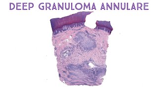 Deep Granuloma Annulare mimic of rheumatoid nodule amp epithelioid sarcoma Emory case 2 [upl. by Clarkin]