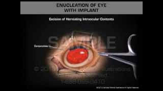 Enucleation of Eye with Implant [upl. by Ssirk156]