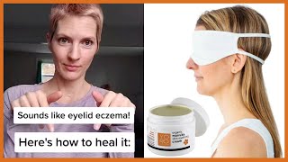 How to Heal Your Eyelid Eczema Naturally [upl. by Picardi235]