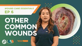 Wound Care Essentials Video 6 – Other Common Wounds [upl. by Einolem418]