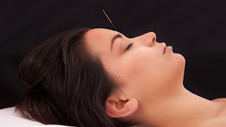 Acupuncture Migraine Relief [upl. by Berti]