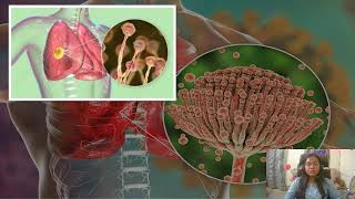 Aspergillosis The Infectious Fungal Disease [upl. by Symer]