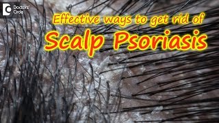 Scalp psoriasisSymptom Cause Treatment  Safe ways to Wash Hair Dr Rasya Dixit Doctors Circle [upl. by Volkan]