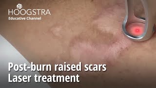 Postburn raised scars  Laser treatment  22242 [upl. by Gay]