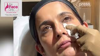 Profhilo Treatment Live  Dr Reema Arora  The Face Clinic  South Delhi [upl. by Eerehc746]