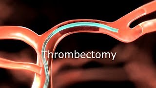 Thrombectomy Animation [upl. by Leber]