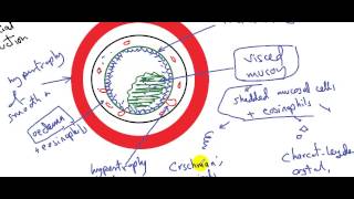 systemic pathology respiratory system bronchial asthma DR SAMEH GHAZY [upl. by Lezirg]